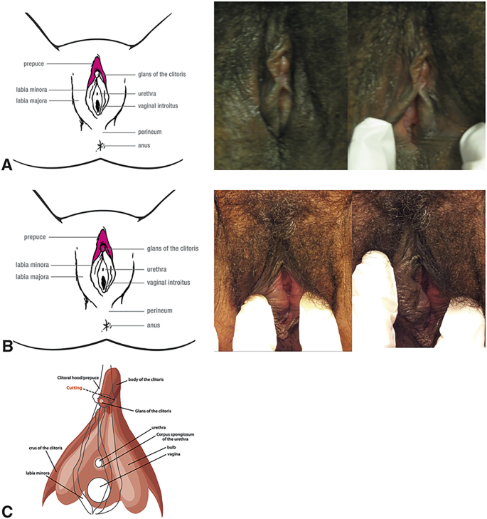 cut clitoris Female Genital Mutilation/Cutting | SpringerLink