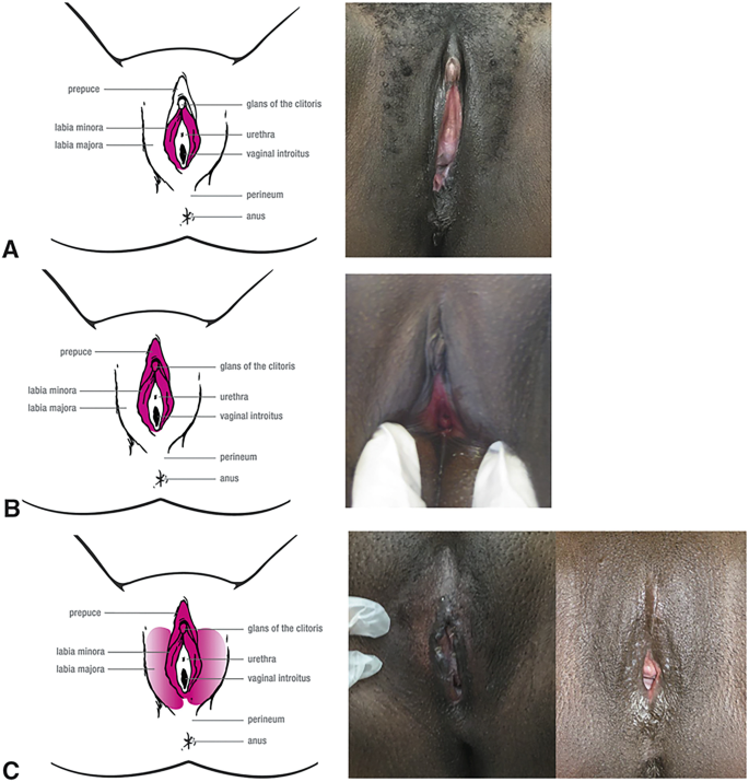 cut clitoris 
