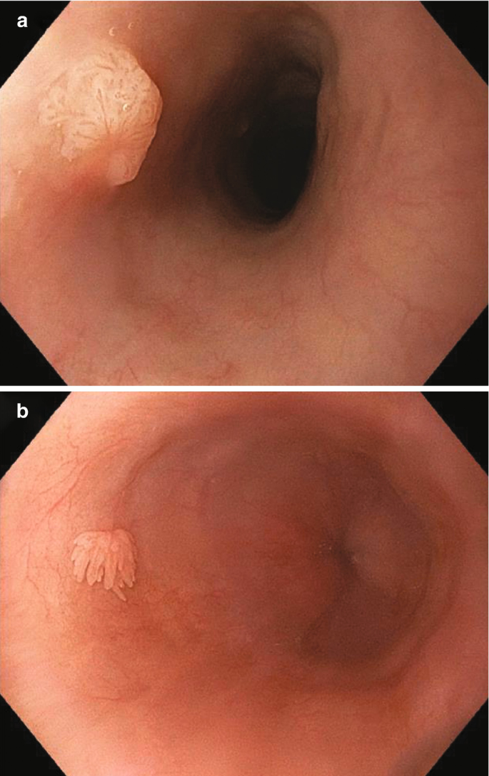 Erythematous nodule with central hole on the inferior middle third of