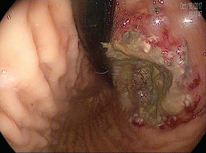 A photograph of a giant deep gastric ulcer caused due to mucormycosis.