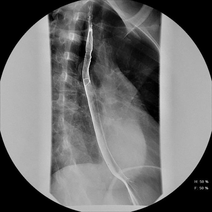 The fluoroscopic image of the esophagus of a patient with E o E. The esophagus tube is narrower at the top and some proximal stricture can also be seen.