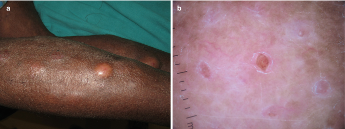 (a) A photograph of medium-sized inflammations on the legs of a man. (b) A close-up view of the inflammations displays the change in hue and skin irritations.