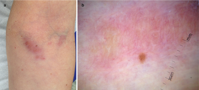 (a) A photograph of the medium-sized patches on the arms of a man. (b) A close-up view of the patches displays the change in hue and skin irritations.