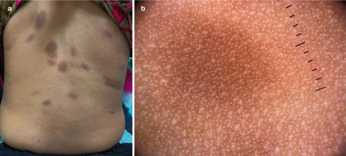 (a) A photograph of many medium-sized inflammations on the back of a man. (b) A close-up view of the inflammation on the skin darkens the pigment of the man's skin.