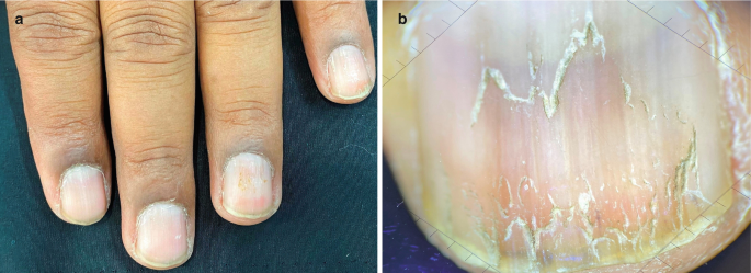 Two photos. A. a close-up view of 4 fingers and B. a close-up view of a nail. The nail is dry and has a sequence of V-shaped marks at the tip and in the center.