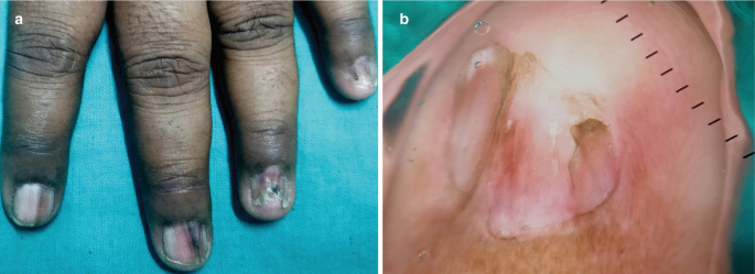 Two photos. A. a close-up view of 4 fingers and B. a close-up view of a nail. The nails have dark, thick lines and broken nails.