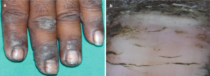 Two photos. A. a close-up view of 4 fingers and B. a close-up view of a nail. The nail has dark, irregular horizontal lines, and the skin around it is very dark and dry.