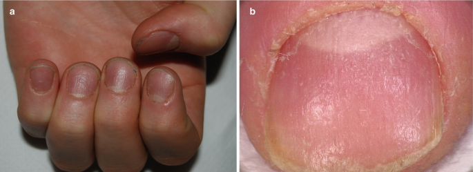 Two photos. A. a close-up view of hands focusing on the nails and B. a close-up view of a nail. The nail is thin and has a shiny shade. Many thin lines run from tip to bottom.