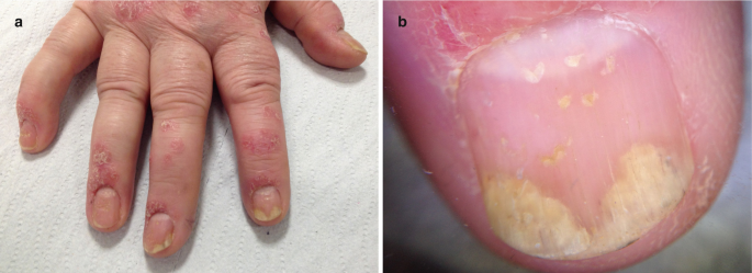 Lung Cancer and Nail Clubbing