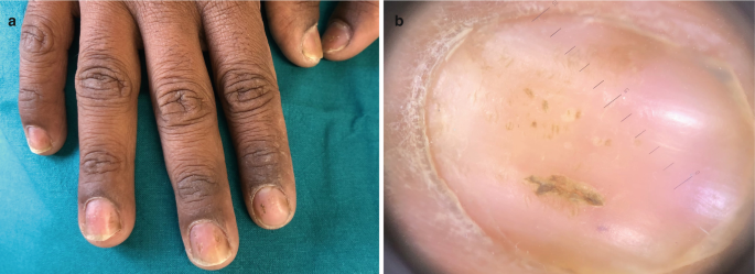 Systemic Therapy for Nail Psoriasis
