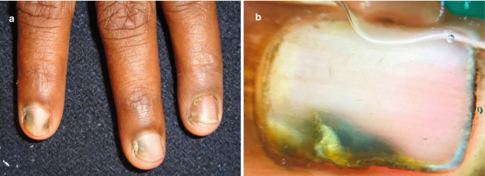 JoF | Free Full-Text | Efficacy of Propolis Gel on Mature Biofilm Formed by  Neocosmospora keratoplastica Isolated from Onychomycosis