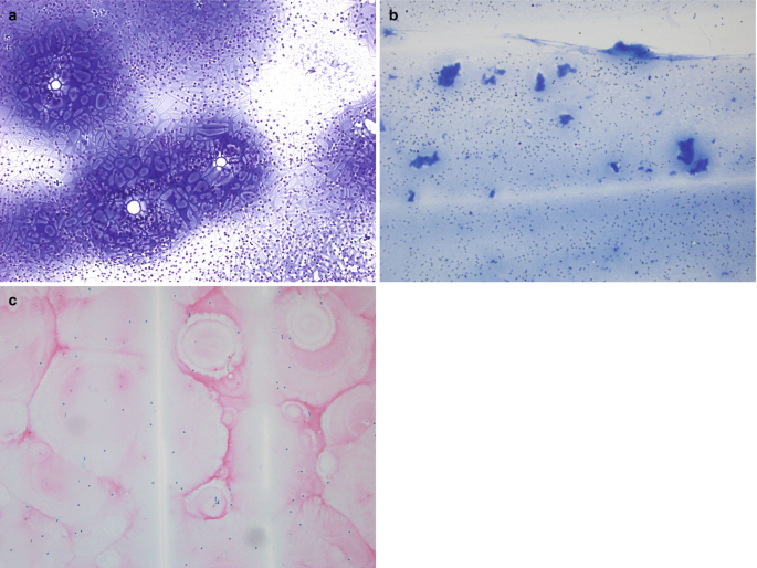 Three ultrasound images of the thyroid gland highlight a watery colloid that appears bluish or pinkish when treated with different staining procedures. Irregular contours with pink borders and vertical white lines are seen in the third image.