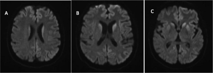 3 images of the axial sections of the diffused weighted image with degenerating cerebral cortex and the space of ventricles are also reduced in the third image.