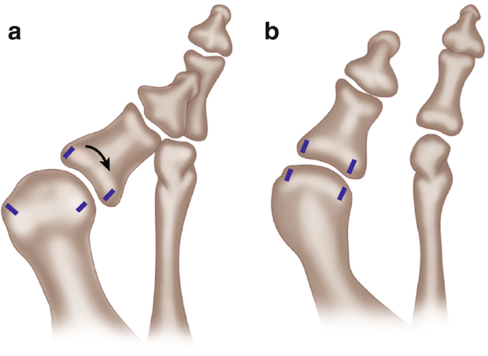 2 Diagrammatic illustrations compare the articular surfaces of metatarsal joints. A, presents the incongruent bone that is bent. B, presents the congruent bone in alignment with the next bone.