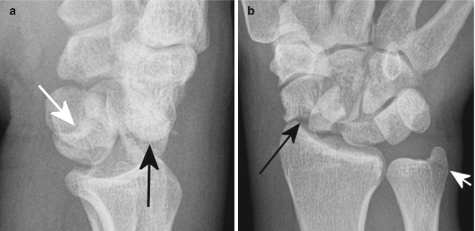 Two X-rays of the fractured wrist. The position of the capitate is seen and it is dislocated from its position.