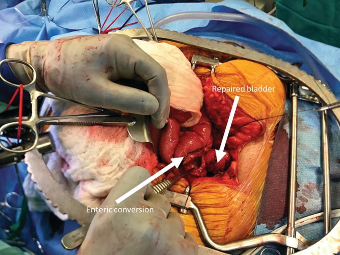 A photograph of a scissor-shaped surgical device with a flat front inserted to support one side of the organ. A sharp pointed device is impregnated for the enteric conversion of the mass attached to a thread.