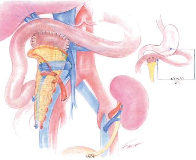 An illustration of the organ transplant with anastomosis of the portal vein to the recipient's superior mesenteric vein. A segment is created by duodenojejunostomy with a dimension of 40 to 80 centimeters.