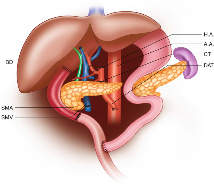 An illustration of the organ transplant with parts labeled B D, H A, S M A, S M V, D A T, C T, and A A.