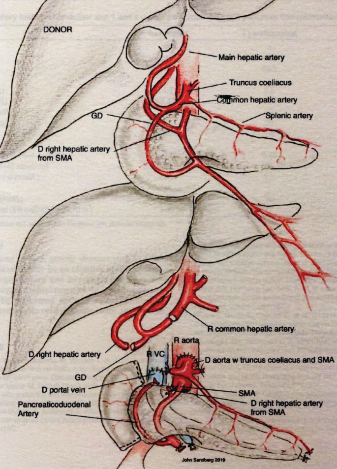 An illustration of the pancreas and liver transplant. The parts labeled are donor right hepatic artery from S M A, main hepatic artery, truncus coeliacs, common hepatic artery, splenic artery, recipient common hepatic artery, donor aorta with truncus coeliacs and S M A, etcetera.