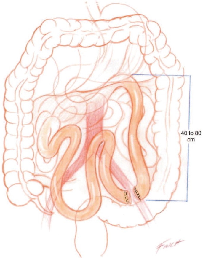 An illustration of the intestine with the jejunum divided into dimensions 40 to 80 centimeters.