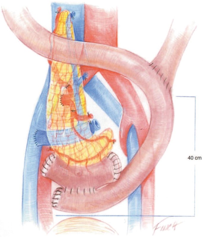 An illustration of the organ transplant with the side-to-side duodenojejunostomy. The organ segment is marked as 40 centimeters.