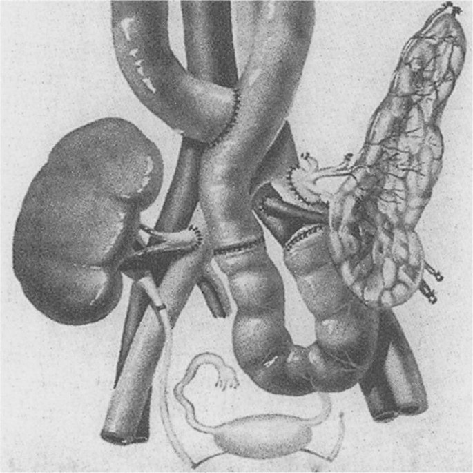 A diagram of a pancreas transplant. The exocrine secretion is done with internal exocrine drainage using a Roux-en-Y duodenojejunostomy.