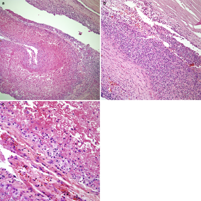 3 histological scans of fibrinous pleuritis, a to c. The structure in a consists of several layers with a narrow gap in the middle. The structures in b and c have narrower and more frequent gaps. The structures in all scans are spread with seed-like cell particles.