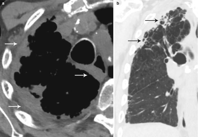 A 2-part scan labeled a and b. A is a C T scan of the upper thorax with right arrows pointing to the swollen cell walls. B is a C T scan of the left lung with two arrows pointing to tiny dark cell masses on the top-left side.