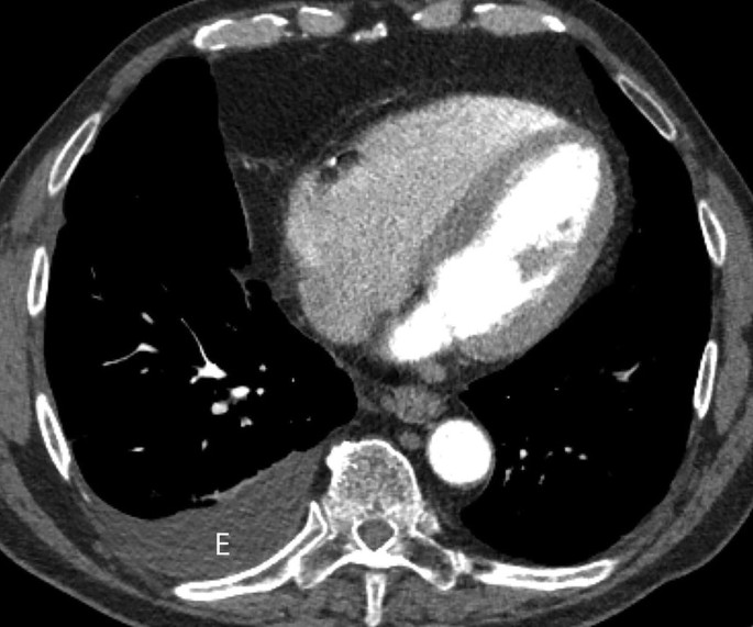 An axial C T scan of the lungs. The bottom left cell wall is swollen and labeled E. There are oval bright cell masses on the top and in the center. There are minute bright spots in the left and right gaps.