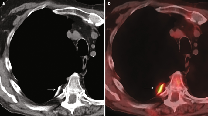 A pair of C T scans of the posterior right pleural space labeled a and b. Scan b has a warm tone. A right arrow point to a narrow tubular cell structure on the left side of the conical structure on the bottom.