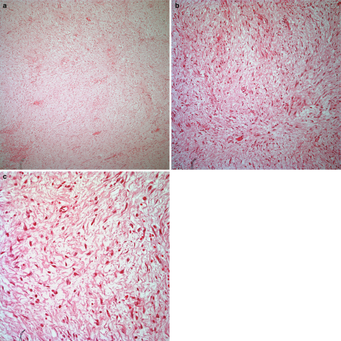 3 histological scans of the desmoid tumor of the pleura, a to c. The surface layer is spread with minute cell particles in a. B and c are the magnified views of cell particles.