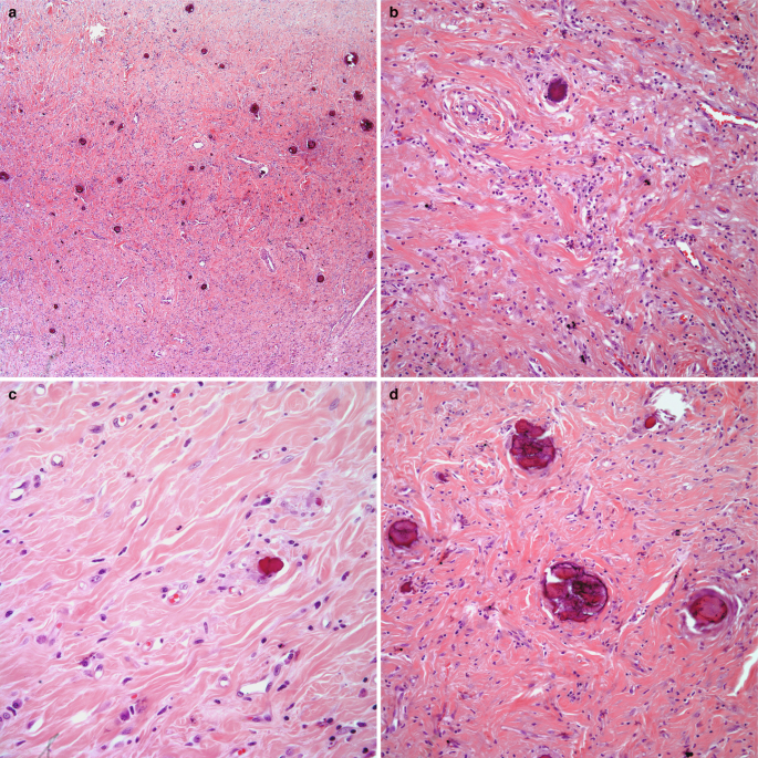 4 histological scans of the pleural calcifying fibrous tumor, a to d. The surface layer in a is spread with grain-like particles and a few round cell masses. The grain-like particles are magnified in b and c. The scattered round cell masses are magnified in d.