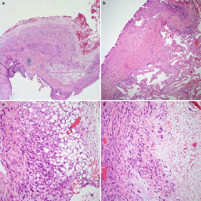 7 histological scans of the pleural E H E, a to g. Scan a has a bent cellular structure. B is a magnified view of the cellular lining with gaps in between. C and d are magnified views with an increased diameter of the scattered grain-like cell particles and bubble-shaped gaps. E to g are magnified views of the particles.