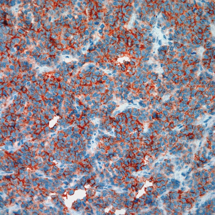 An immunohistochemical staining scan of P N E T with positive C D-99. The surface is spread with pebble-like particles entangled in mucoid material.