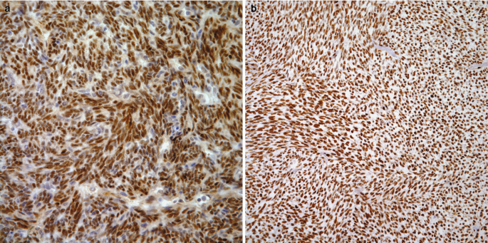 2 immunohistochemical staining scans of the T L E-1, a and b. The surface layer in a is densely packed with two types of seed-like cell particles. The surface layer in b is densely packed with only one type of cell particle. The particle size in b is smaller than that of a.