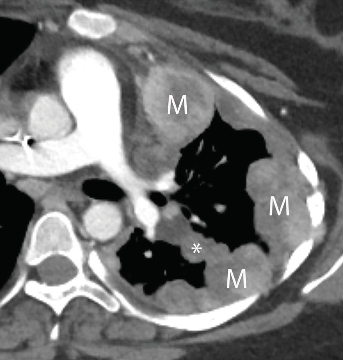 An axial C T scan of the gluteal synovial sarcoma. Round and swollen cell masses on the top right, right, and bottom sides of the inner cell wall are labeled M. An asterisk is on a small round cell mass attached to the bottom swelling.