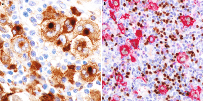 2 stained micrographs have large, abnormal lymphocytes with more than one nuclei. They stain dark for C D30 and light for PAX5.