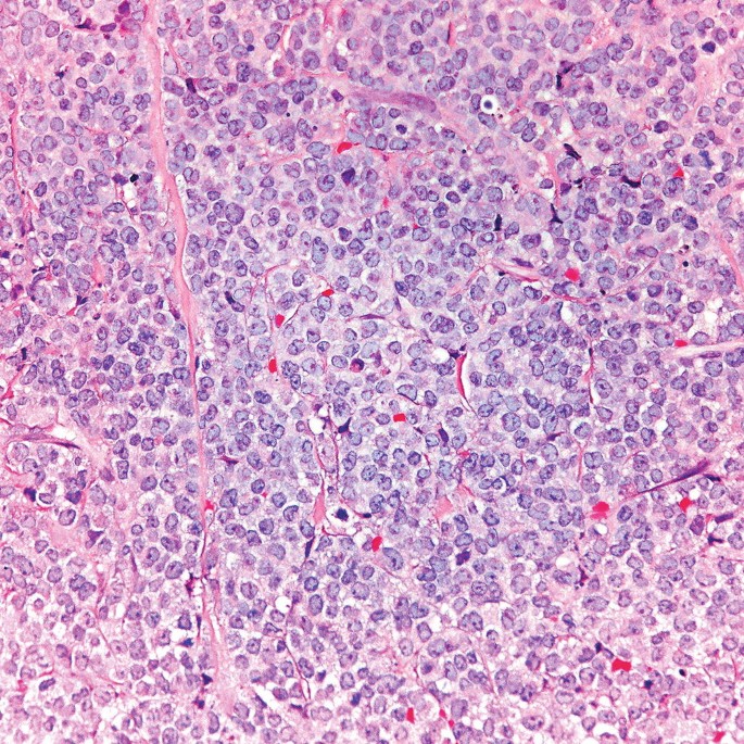 A micrograph has a mass of large leukocytes. It is filled with a few dots or a nucleus.