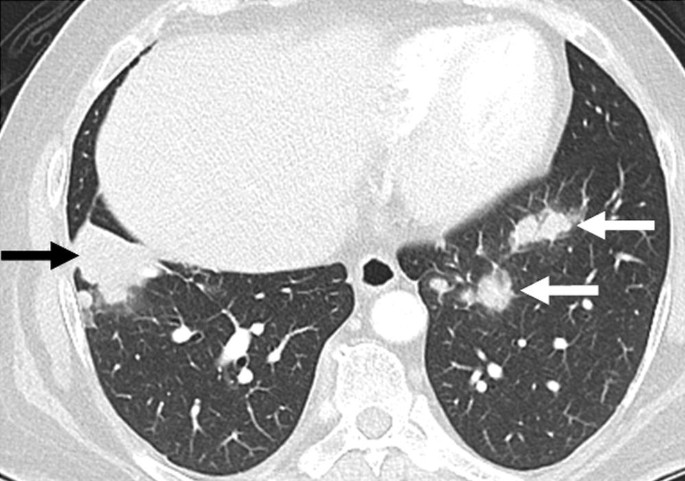 A C T scan shows a big mass on the left-hand side lung and two small masses on the right-hand side lung.