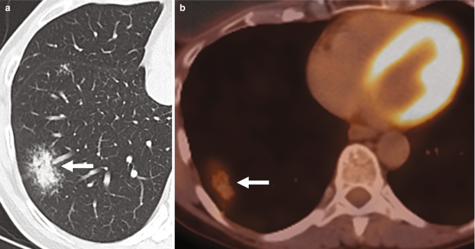 A C T scan shows a radiating nodule below. P E T C T shows the same nodule.