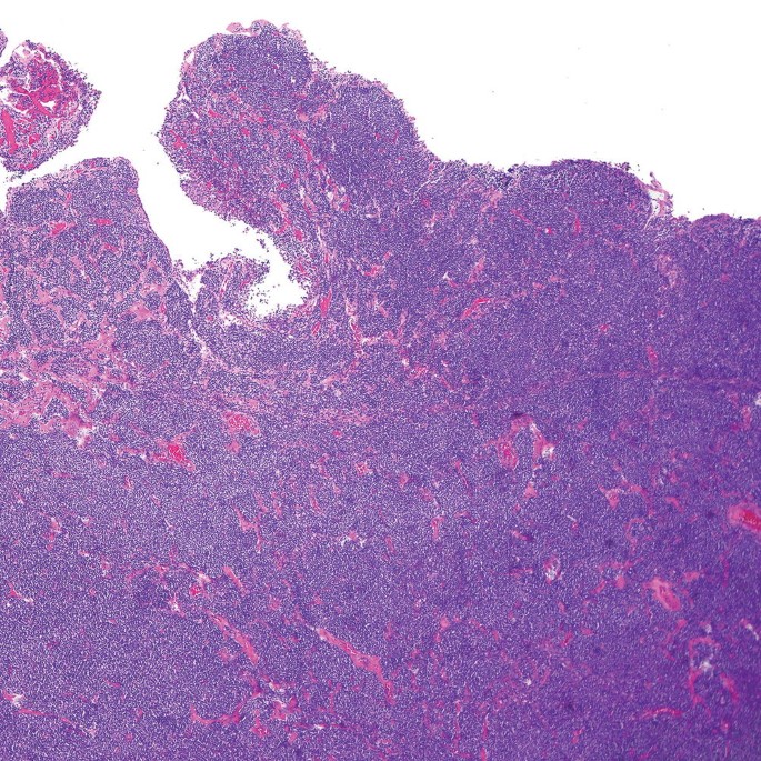 A long distant micrograph of a highly dense population of lymphoma amidst a tissue. There are stripes of cavities present.