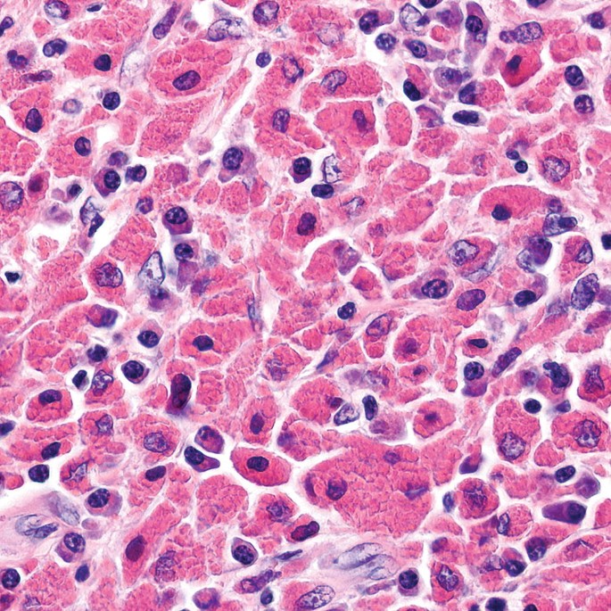 A close-up micrograph of lymphoma amidst a tissue. There is rapid mitosis evident. Few cells have transparent cytoplasm and prominent nuclei.