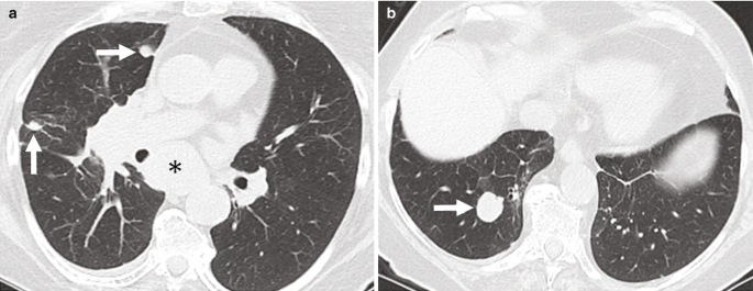 2 C T scans. 1 shows one nodule at the base of the sternum and one in the center of the left lung. 2 shows a slightly larger nodule in the left lung.