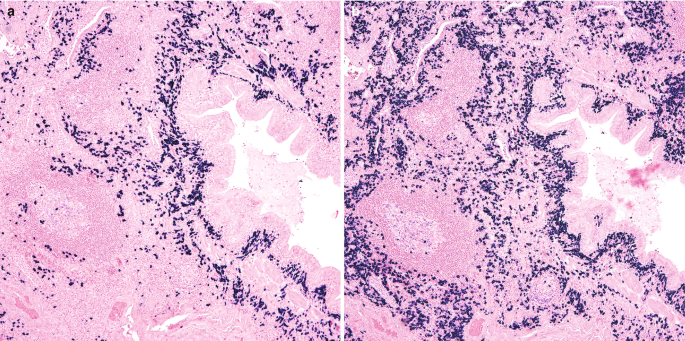 A micrograph confirms the presence of minimally distributed kappa and densely distributed lambda. Both are present in the same locations.