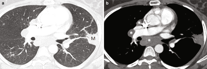 Two C T scans. C T 1 has a small mass stuck to the rear end of the right lung. C T 2 has the same in dark shade.