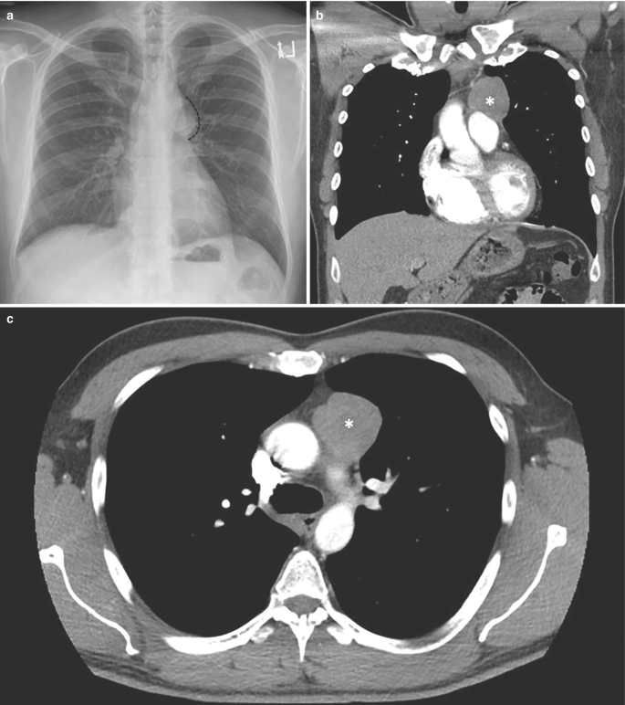 A set of 3 photographs illustrate frontal chest radiograph, coronal and axial C T scans. The latter 2 scans have areas highlighted in lighter and darker shades.