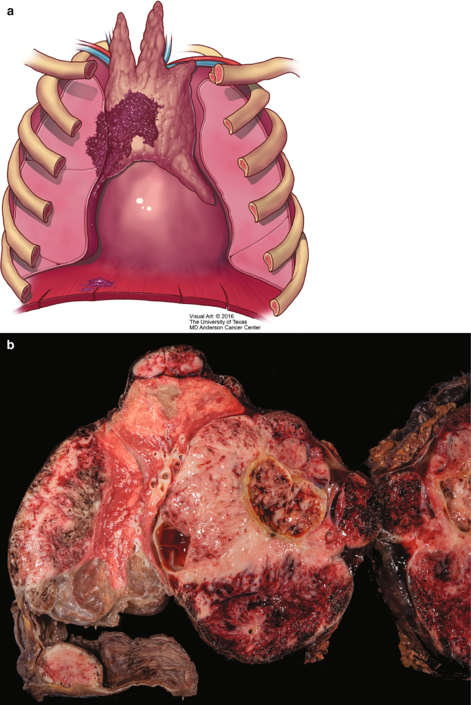 A set of 2 photographs illustrate chest area with the tumor spreading to the right diaphragm, and a detailed view of the dissected tumor present in the diaphragmatic muscle.