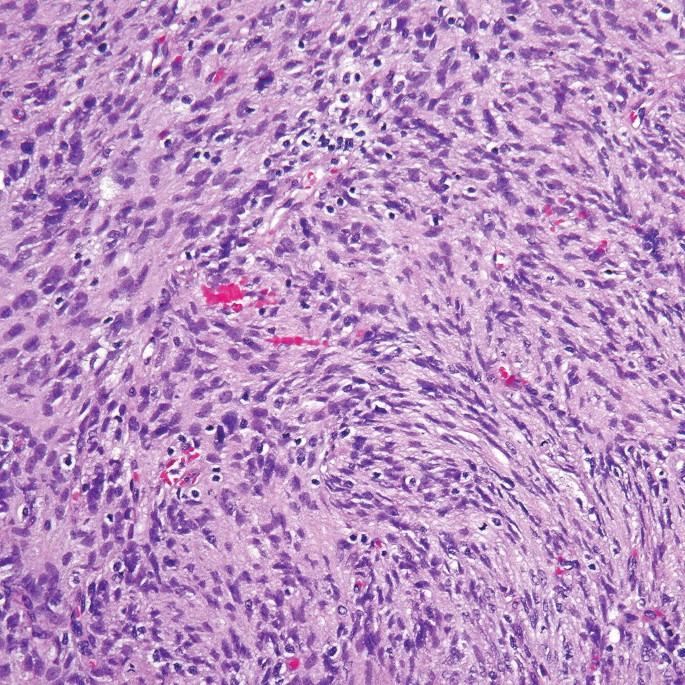 A micrograph of the tumor cells reveals that they are spindly and arranged in short whorls and fascicles. The cells have an elongated nucleus, thick membranes, speckled chromatin, and a large nucleolus.