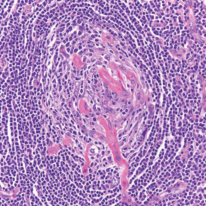 A micrograph of perifollicular blood vessels shows thickened and hyalinized walls, and when these vessels penetrate a follicle, they resemble a lollipop.