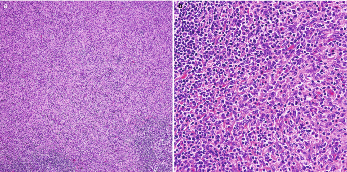 Two micrographs highlight stromal proliferation, where the lymph node is evident, and the same at a higher magnification.